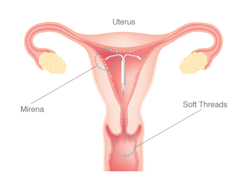 Quy trình đặt vòng tránh thai và vị trí của vòng sau khi đặt.