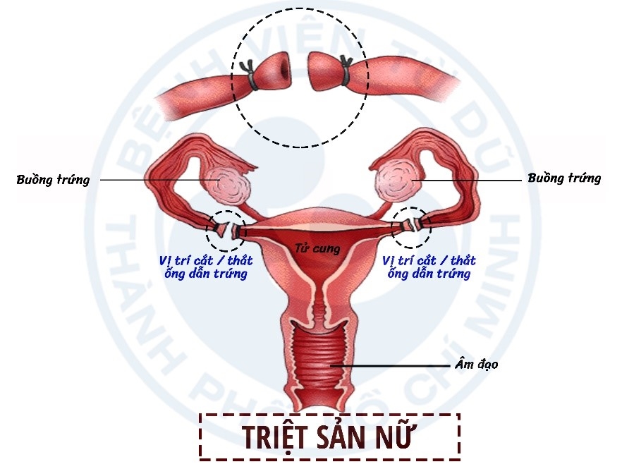 triet-san-nu