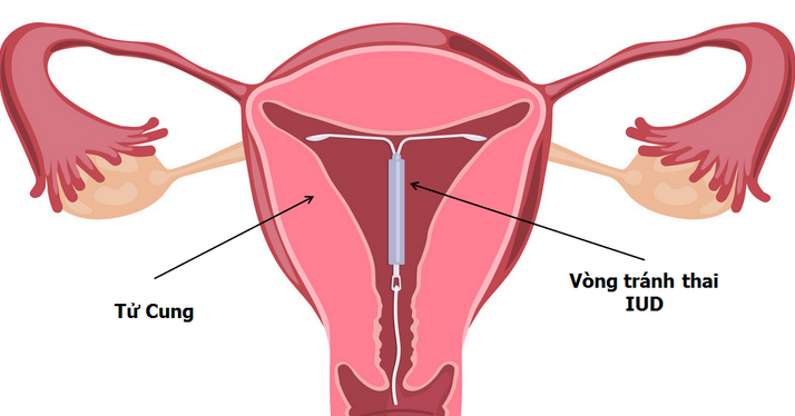 Chọn đặt vòng tránh thai IUD giúp bạn giảm đau bụng kinh và giảm lượng máu kinh.