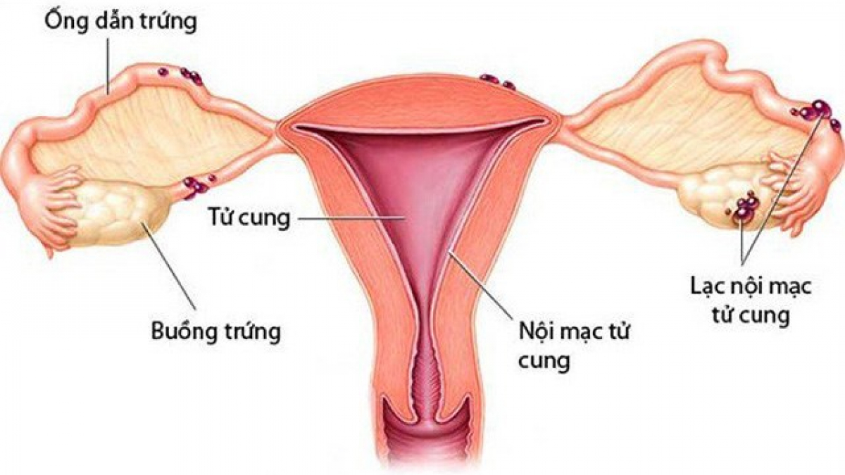 Hình ảnh mô phỏng tình trạng lạc nội mạc tử cung