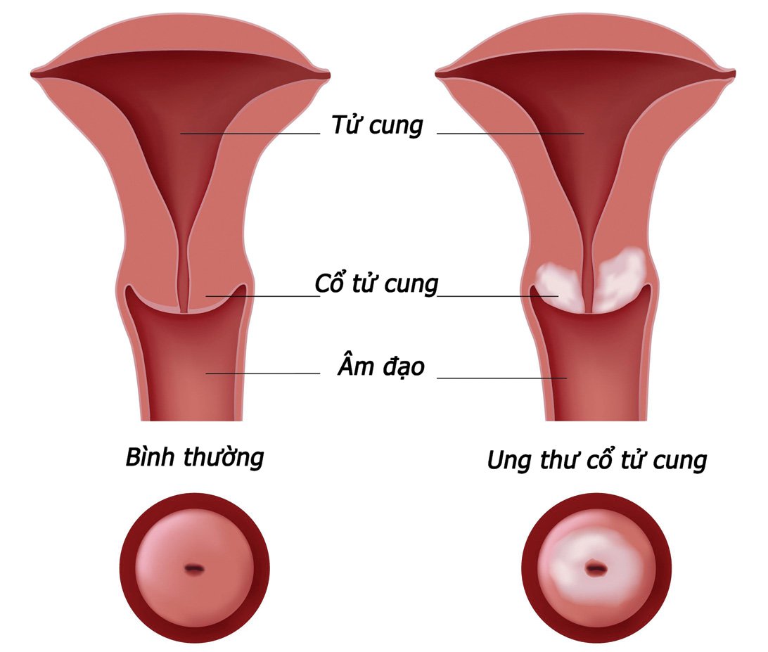 Hình ảnh bệnh ung thư cổ tử cung ở nữ giới