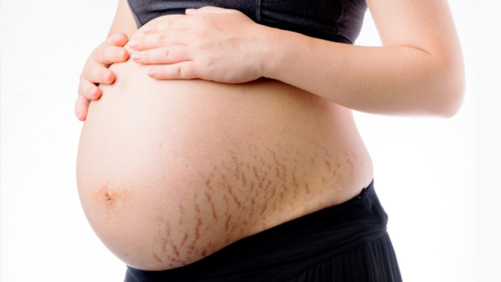 Rạn da do nhiều nguyên nhân nhưng phần lớn là do cơ địa và sự tăng cân đột ngột của cơ thể mẹ