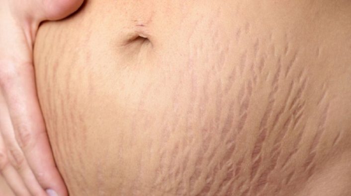 Các vết rạn thường xuất hiện ở vùng bụng, đùi, mông, ngực và bắp tay