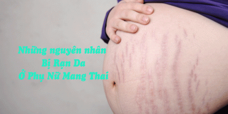 Rạn da khi mang thai xảy ra ở hơn 70% mẹ bầu