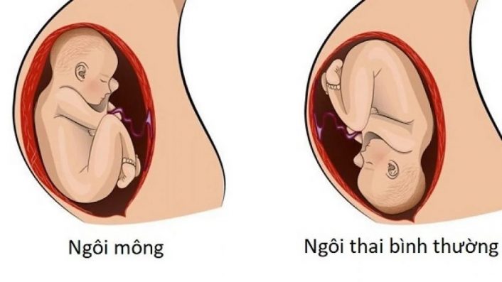 Mông thai hướng về phía cổ tử cung do tử cung có hình dạng bất thườngMông thai hướng về phía cổ tử cung do tử cung có hình dạng bất thường