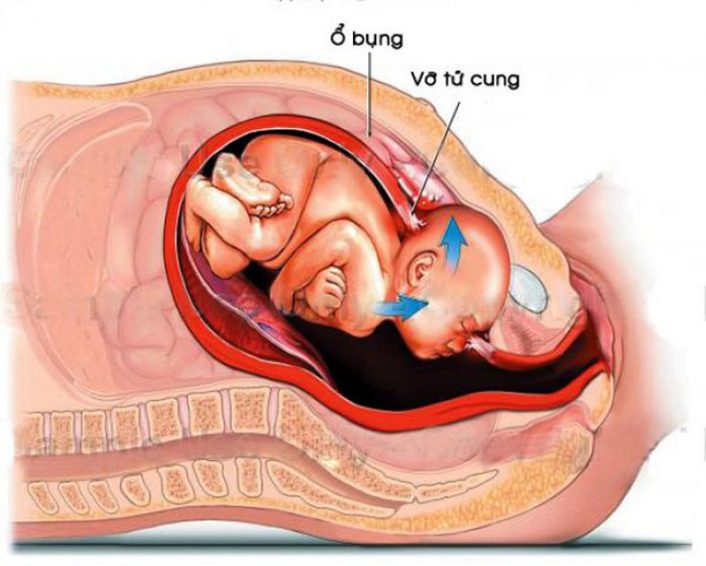 Vỡ tử cung: Máu tụ bị che lấp bởi các cấu trúc trong khung chậu mẹ