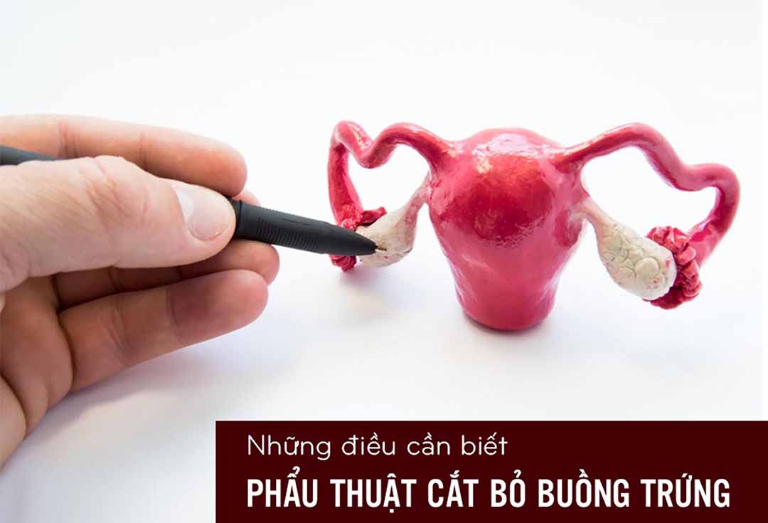 nhung-dieu-can-biet-ve-phau-thuat-cat-bo-buong-trung