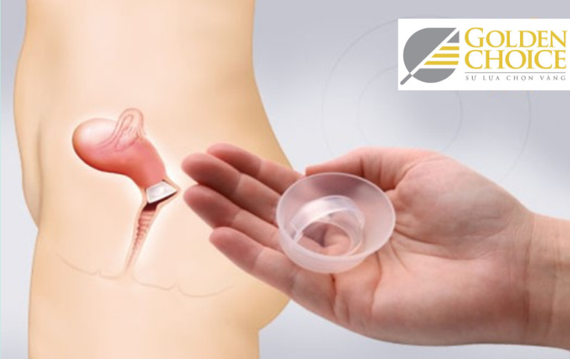 Cervical Cap hay mũ cổ tử cung là chiếc cốc có hình vòm, được làm từ silicone