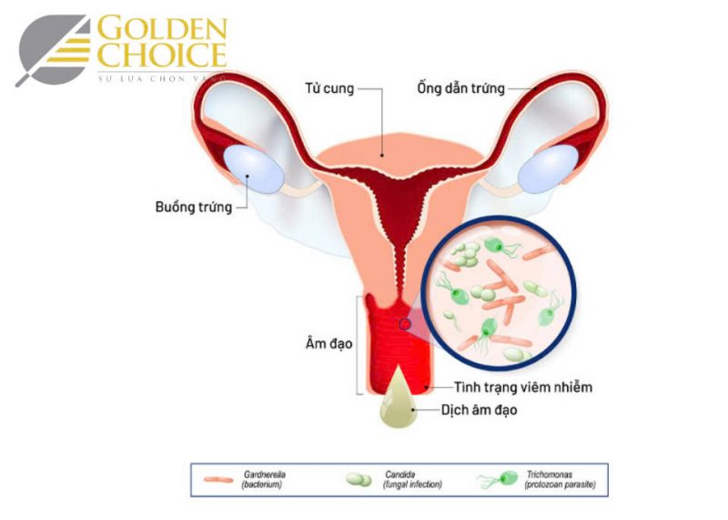 Có nhiều tác nhân gây bệnh viêm âm đạo, vì thế ngay khi có triệu chứng bệnh chị em cần thăm khám sớm để được điều trị đúng nguyên nhân