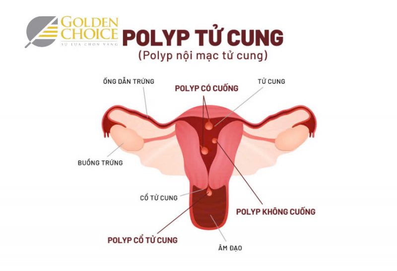 Polyp cổ tử cung là nguyên nhân gây nên hiện tượng ra dịch màu nâu ở nữ giới